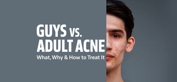 Guys vs. Adult Acne